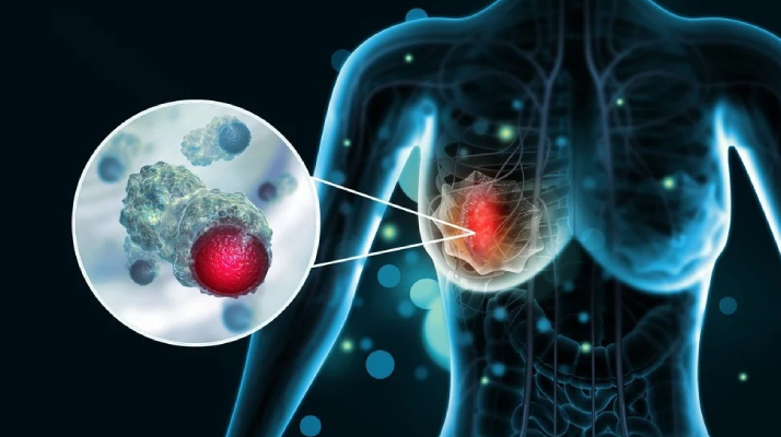 breast cancer treatment
